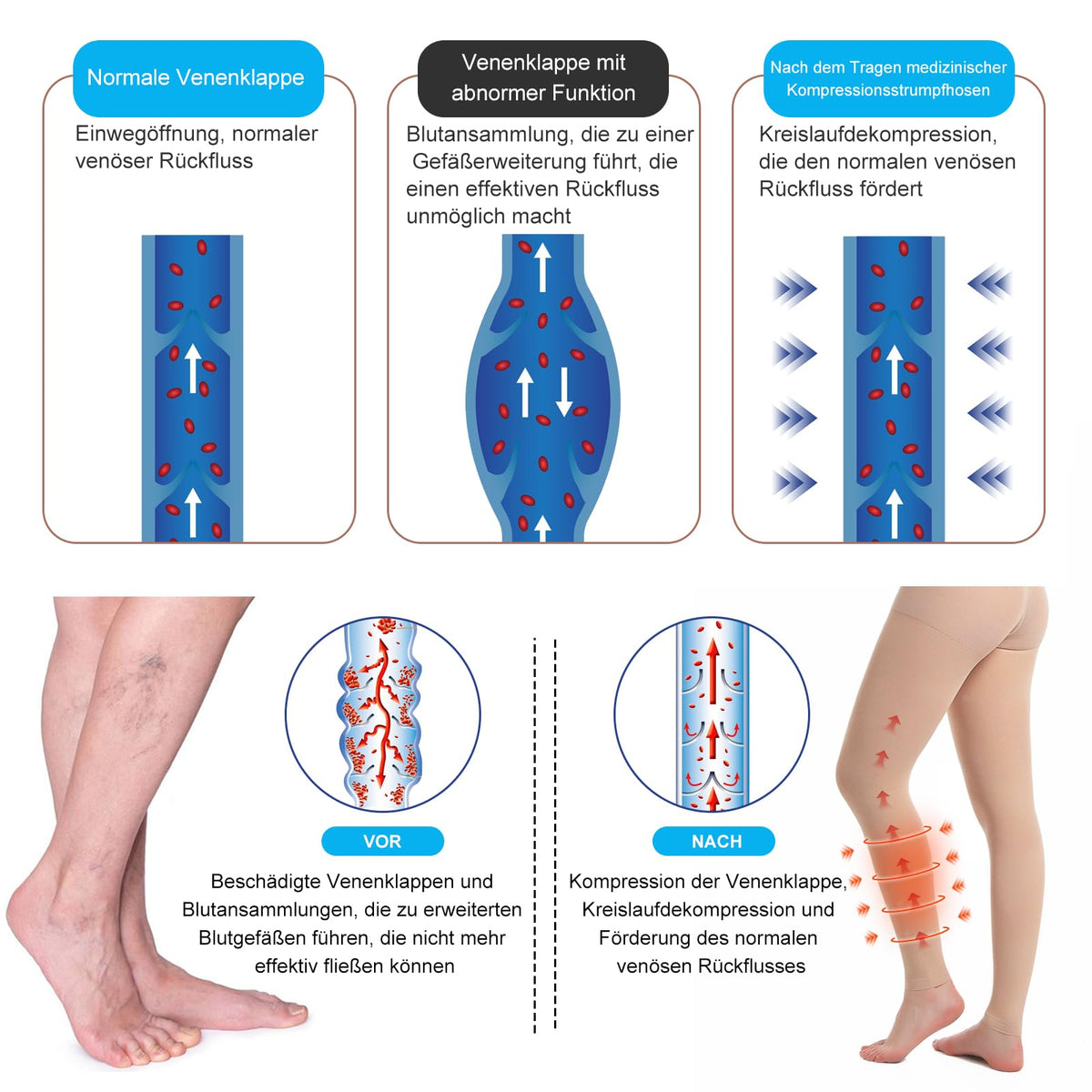 Dresuri compresive medicinale clasa 2 fără vârf 20-30 mmHg pentru varice și edeme – Bej XXL